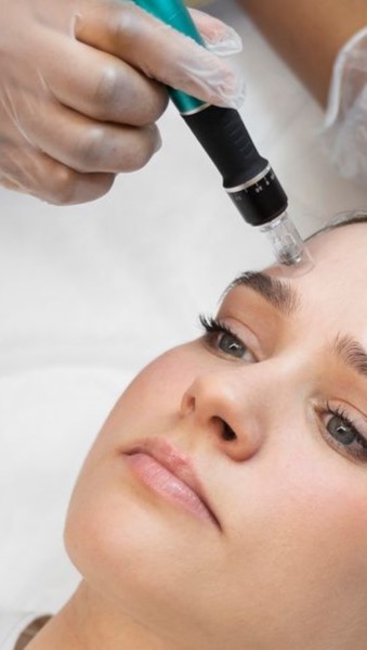 20122024-microneedling_EB-facial Se le induce colágenos.