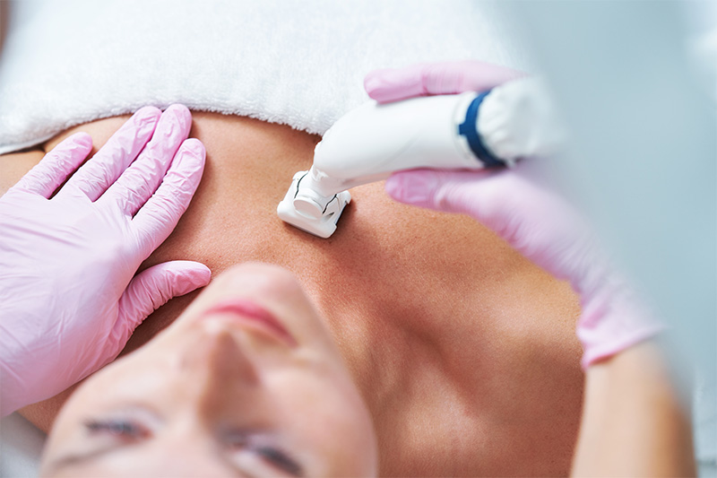 Microneedling Aplicación de tratamiento de Microneedling